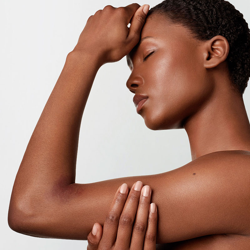 woman with atopic skin