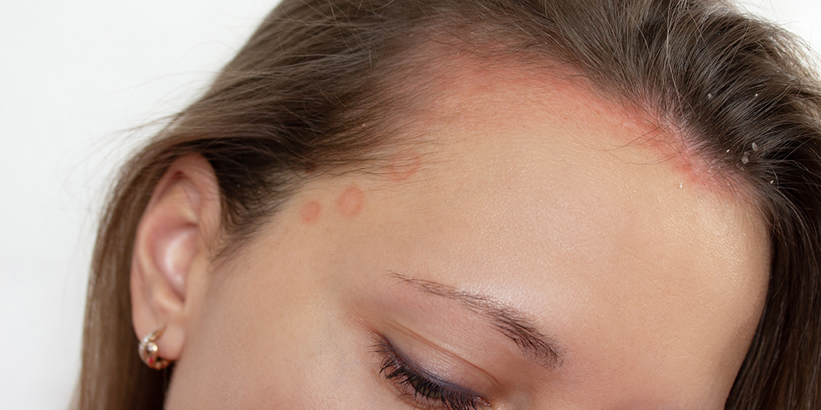 woman with psoriasis