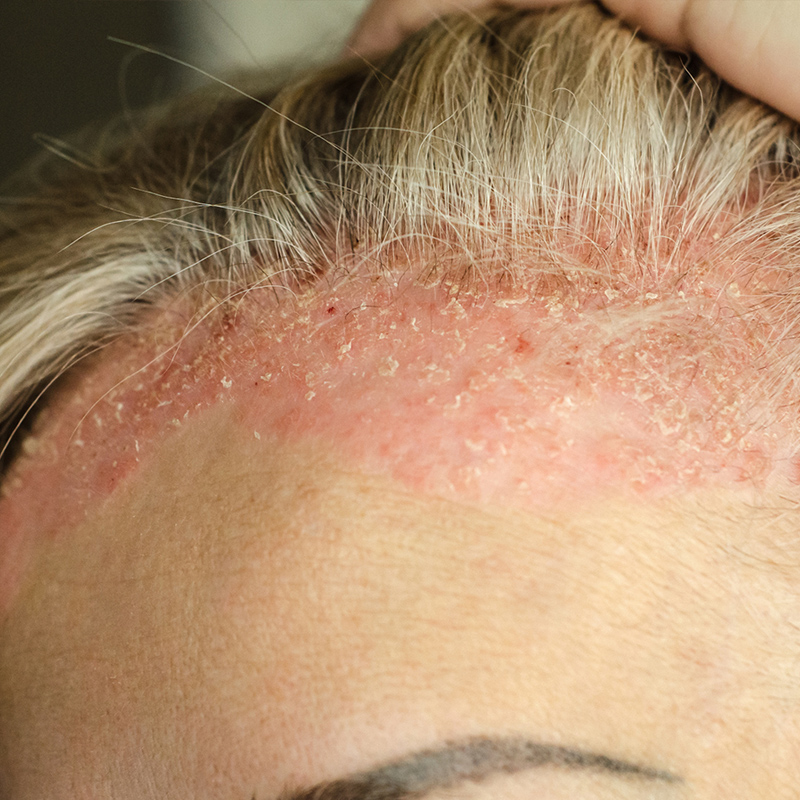 scalp psoriasis