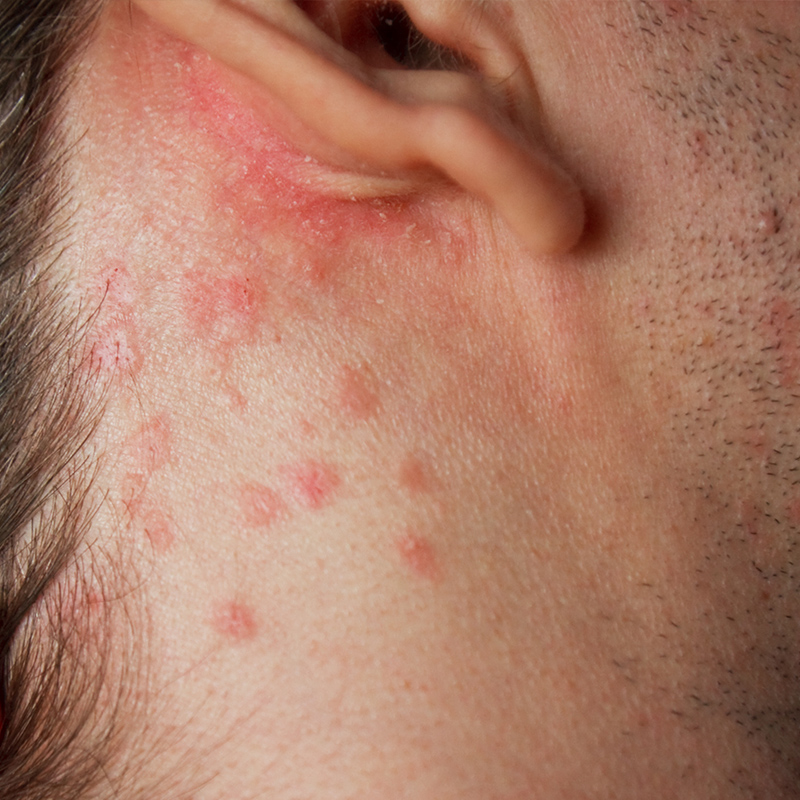 psoriasis around the ear