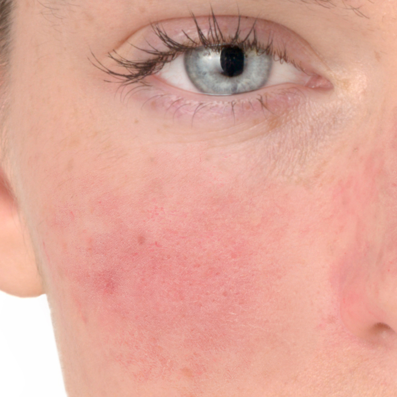 Rosacea symptoms, redness on the cheeks and nose