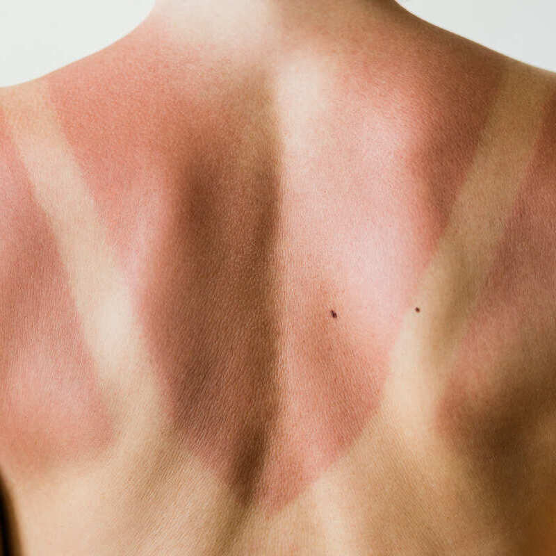 Sunburned back