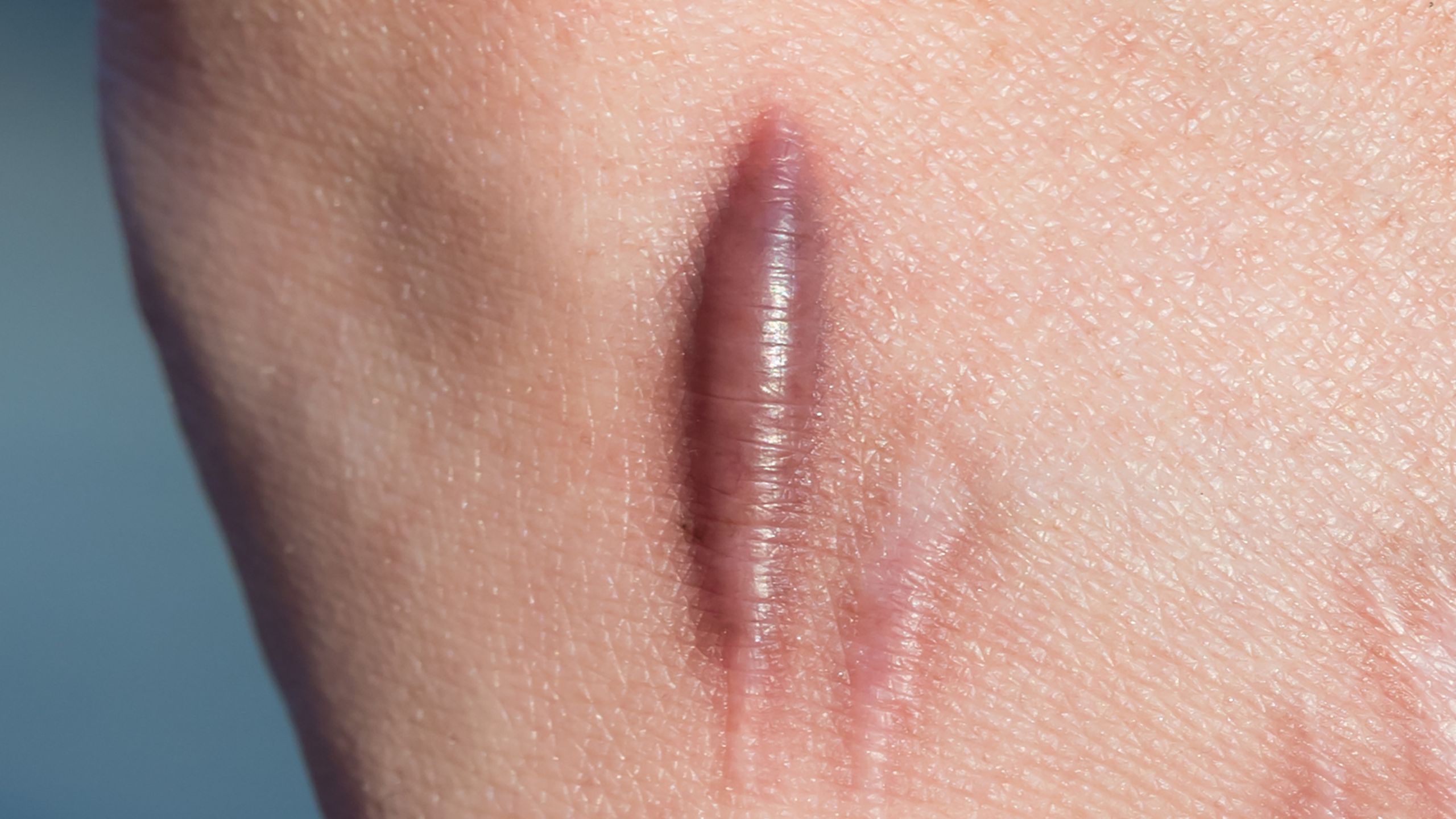 Hypertrophic scar
