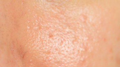 blemished skin images