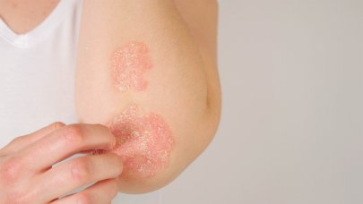  A photo of skin with psoriasis patches